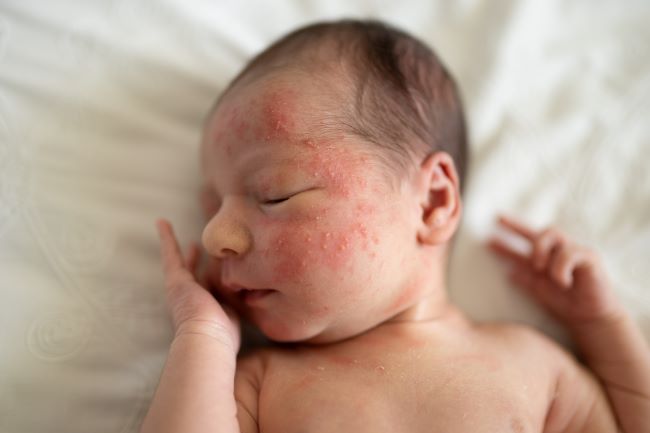 Novorozeně leží na bílé peřince, má zavřené oči, pravou ruku má položenou na tváři, na levé straně obličeje má červené flíčky, akné.