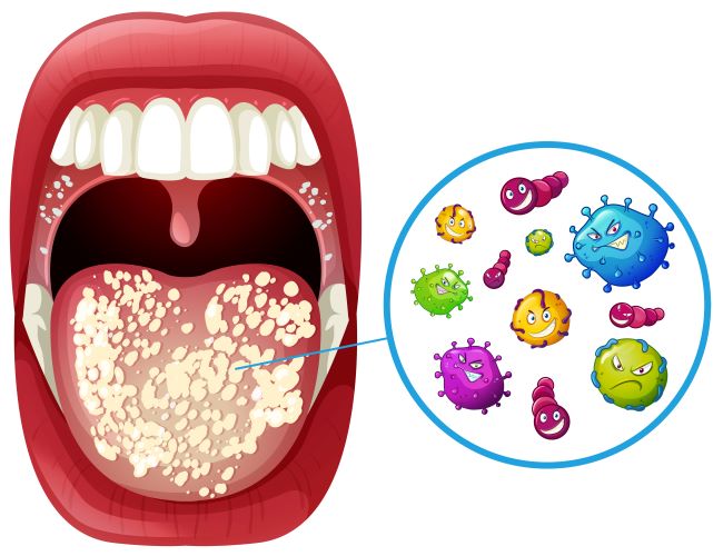 Ilustrace otevřené dutiny ústní, na jazyku je bílý povlak a ilustrované bakterie.