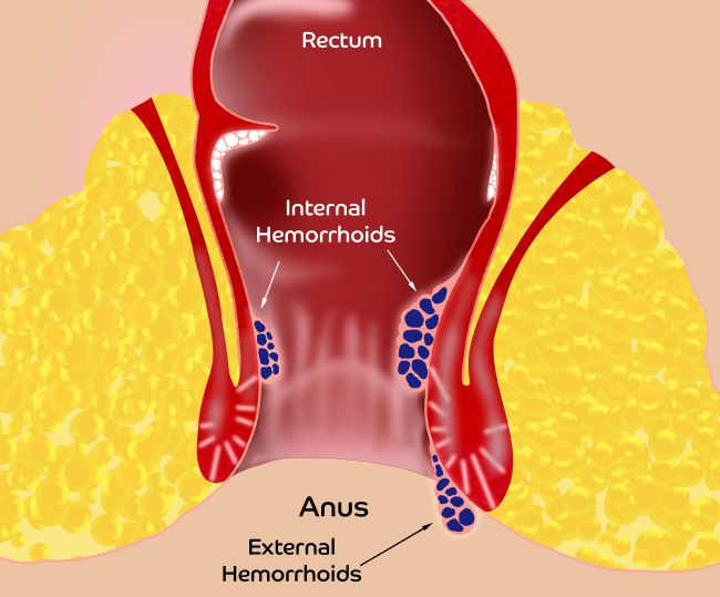 Ilustrace vnější hemoroidy a vnitřní hemoroidy.