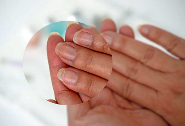 Přiblížený záběr na nehty pravé ruky, které jsou slabé, popraskané.