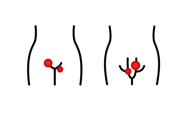 Genitální herpes, ikonka mužského a ženského genitálního oparu vyznačený červenou barvou na místech postižení.