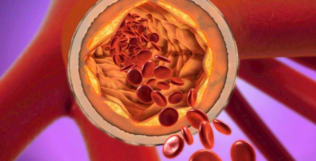 aterioskleroza-vysoky-cholesterol-1024x524