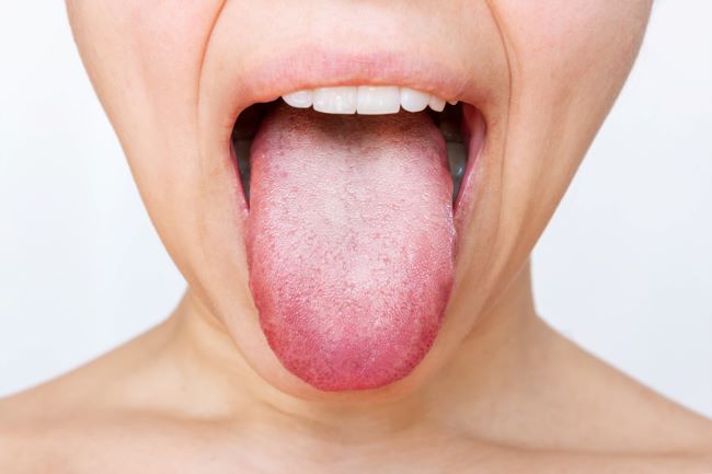 Ženský jazyk s bílým plakem. Oříznutý záběr mladé ženy ukazující jazyk izolován na bílém pozadí. Onemocnění trávicího traktu, dysfunkce orgánů, špatná ústní hygiena, plísňové infekce
